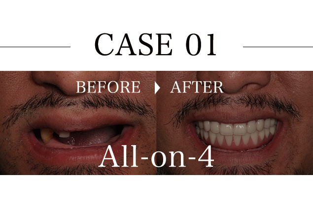 Case01 40代男性上下顎オールオン4インプラント