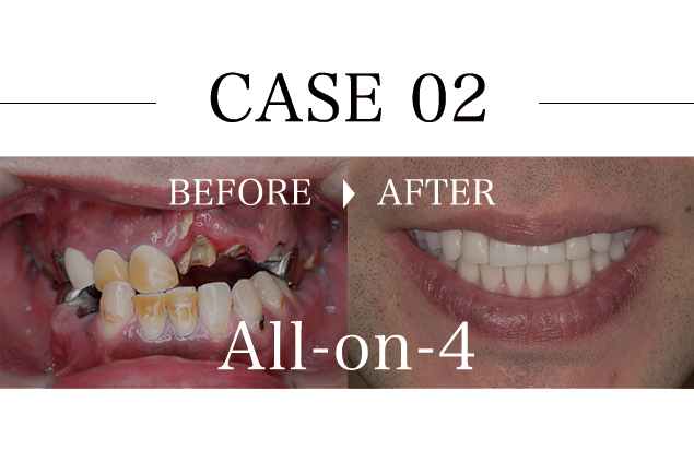 Case02 30代男性上下顎オールオン4インプラント