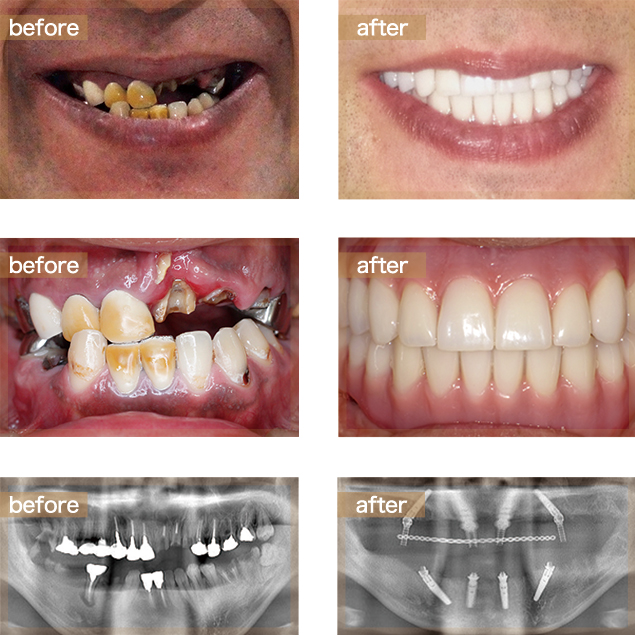 Case02 30代男性上下顎オールオン4インプラント