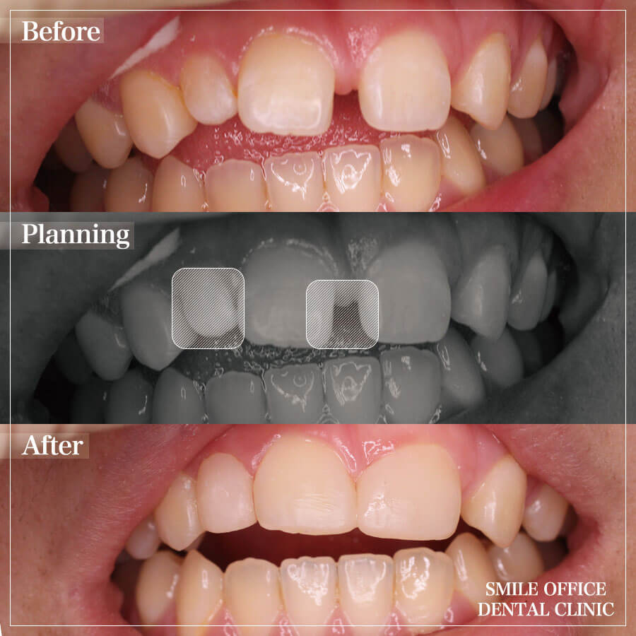 ③上の前歯の隙間と歯の形をダイレクトボンディングで治療