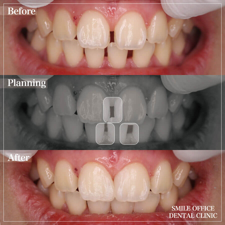 ⑤上下の前歯の隙間をダイレクトボンディングで治療
