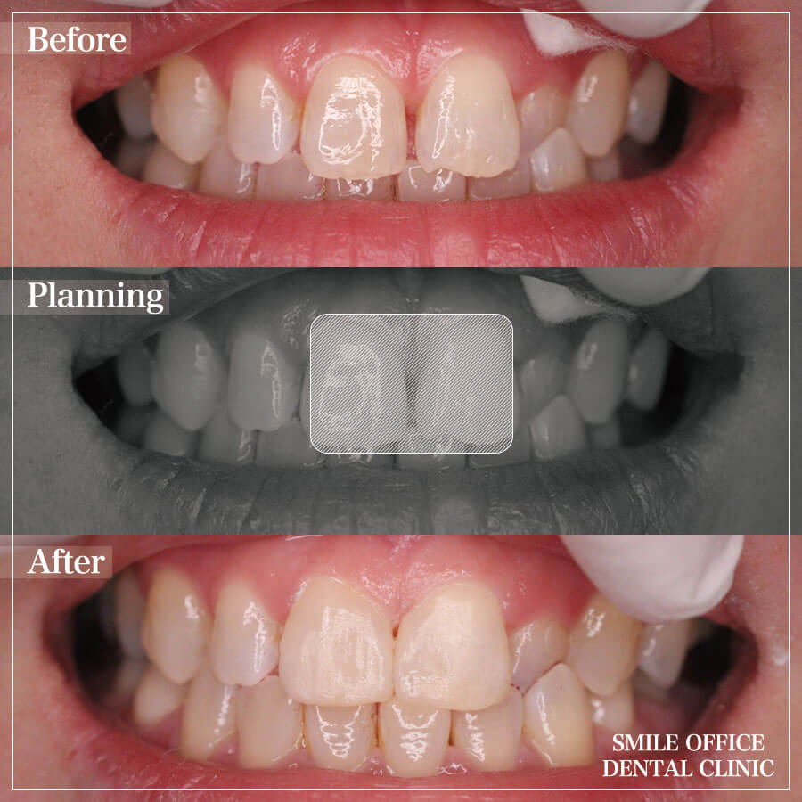 ⑥上の前歯の隙間と形をダイレクトボンディングで治療