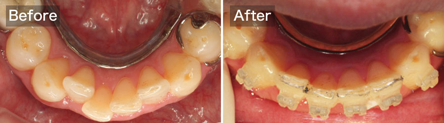 case09.下の前歯の矯正治療前、治療後の写真