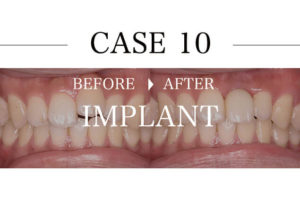 case09.前歯抜歯即時インプラントアイキャッチ