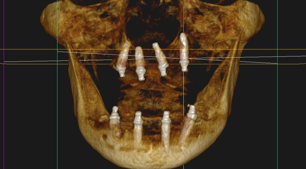 case05.上下顎オールオン4術後CT画像