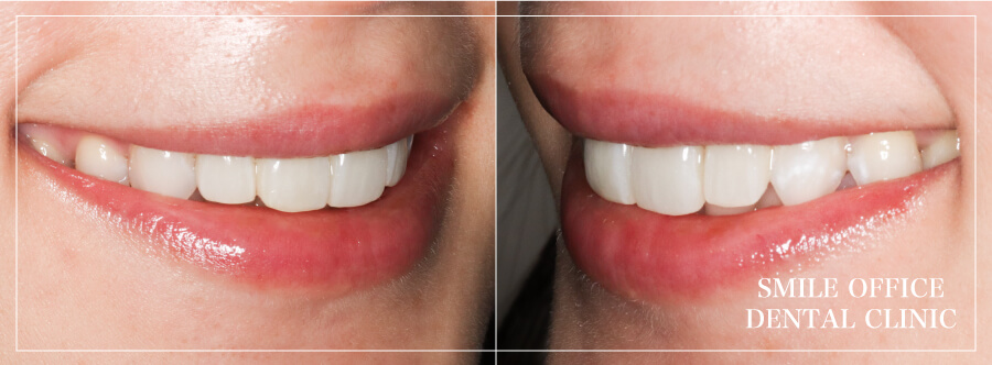 前歯のセラミック症例治療後の左右から見た写真