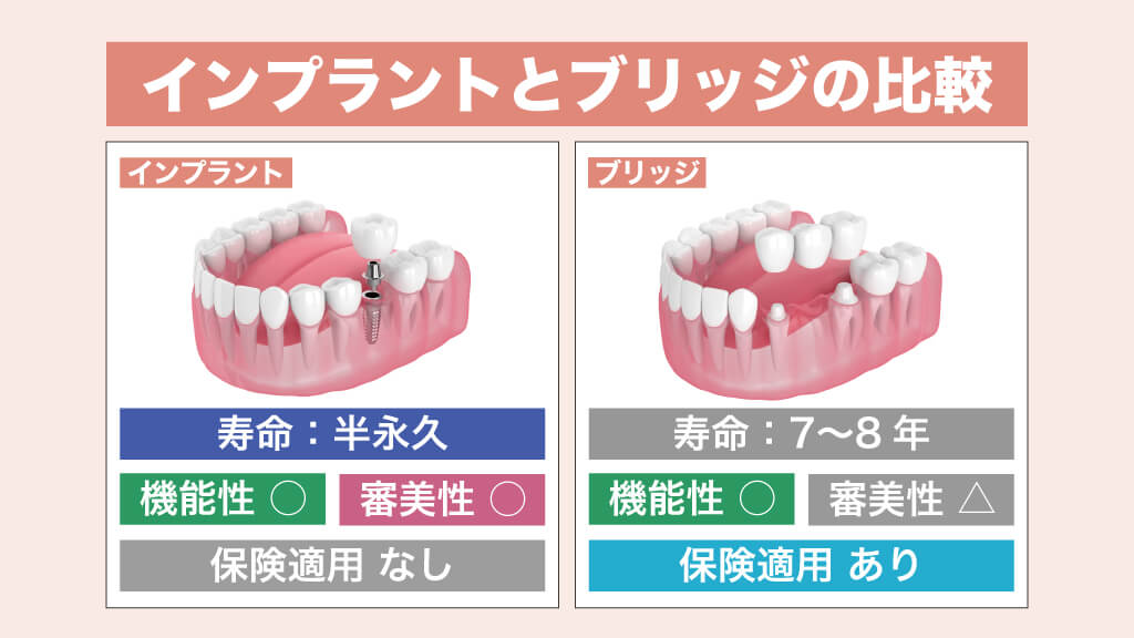 インプラントとブリッジの比較