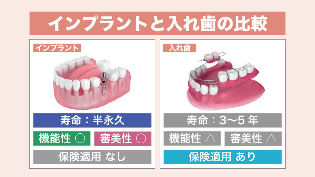 インプラントと入れ歯の比較