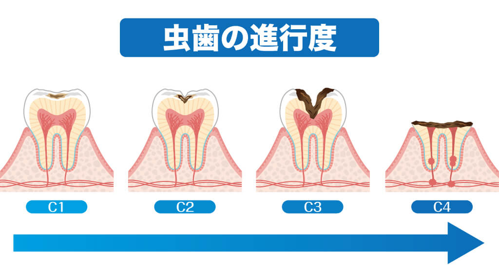 虫歯の進行度