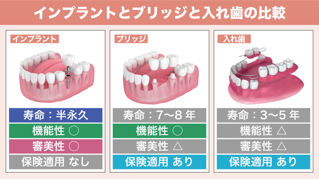 インプラントとブリッジと義歯の比較