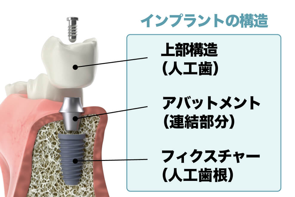 インプラントの費用の内訳