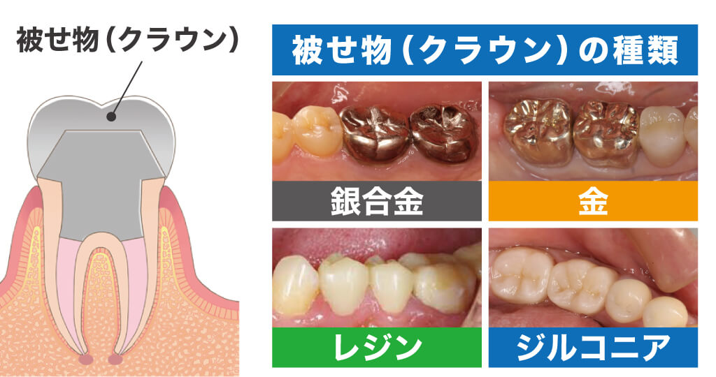 クラウンの種類
