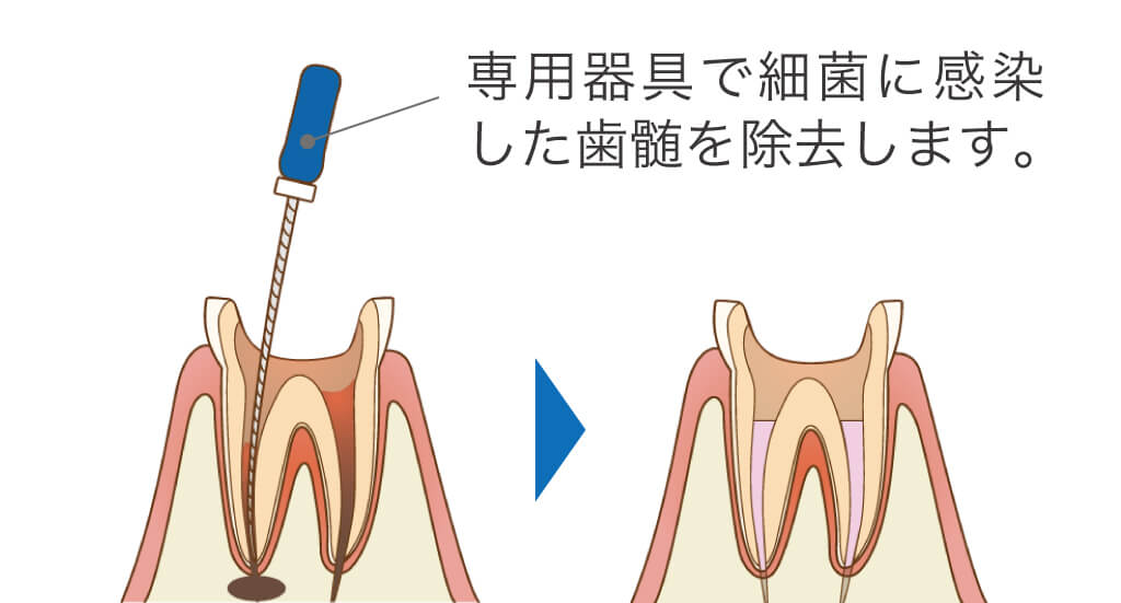 根管治療の流れ