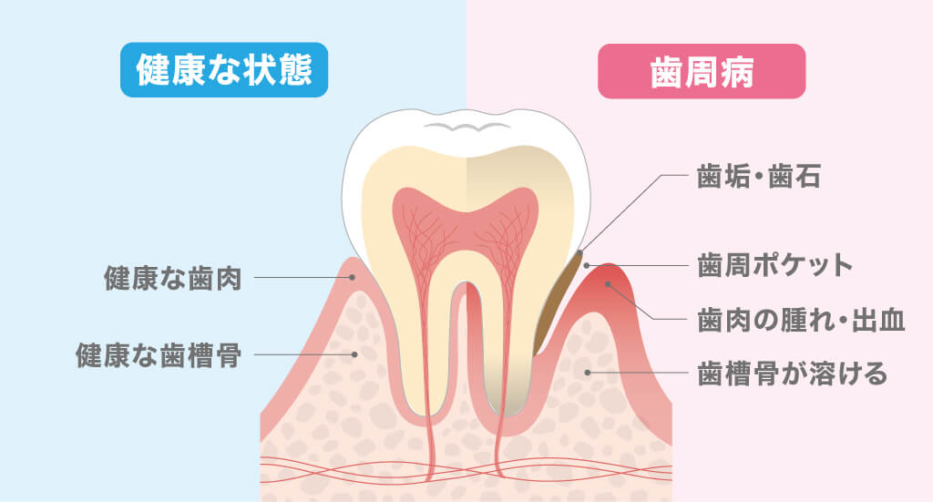 歯周病とは