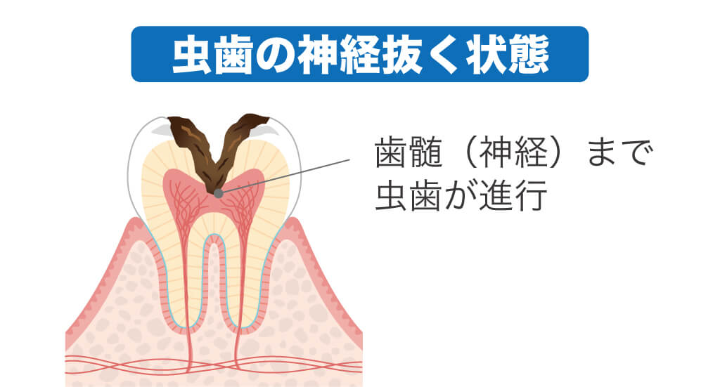 虫歯の神経を抜く状態