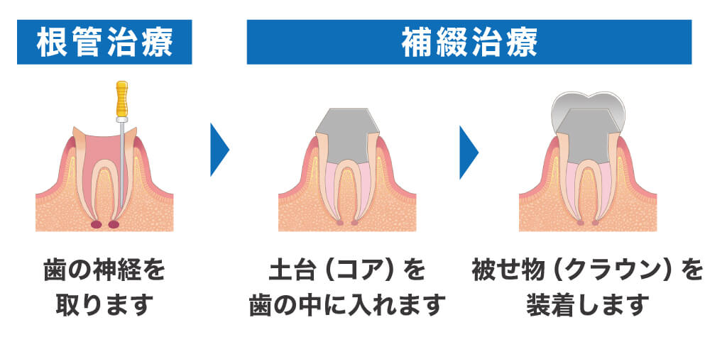 神経を取った後の治療の流れ