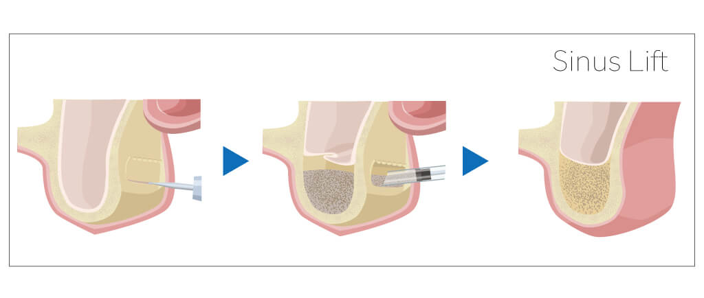 サイナスリフト